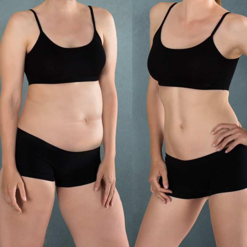 Does Fat Freezing at Home Work? DIY Devices vs Professional Cryolipolysis 2 before and after Cryolipolysis Ashton on Ribble