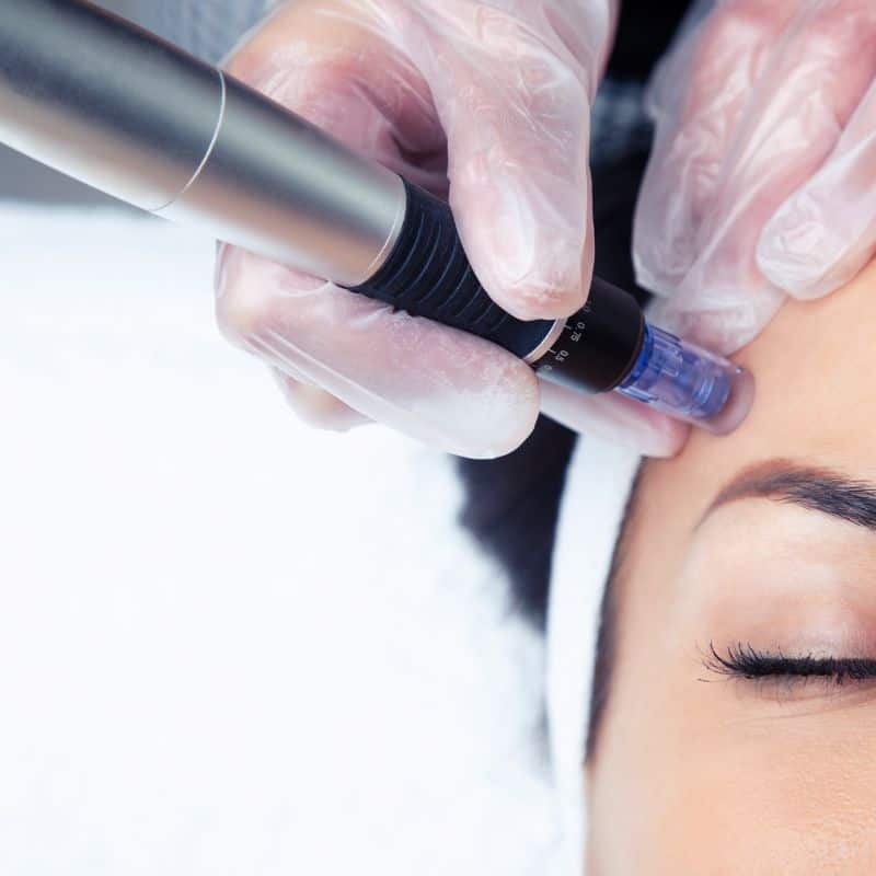 Morpheus8 treatment Ashton on Ribble from Lipo Sculpt - Book in today!