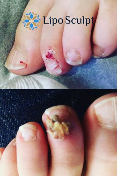 Wart removal customer results from Lipo Sculpt Ashton on Ribble